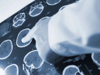 Understanding Epilepsy